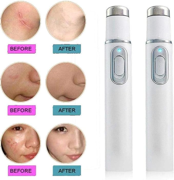 Blue Light Acne Remover Pen – Clear Skin Therapy